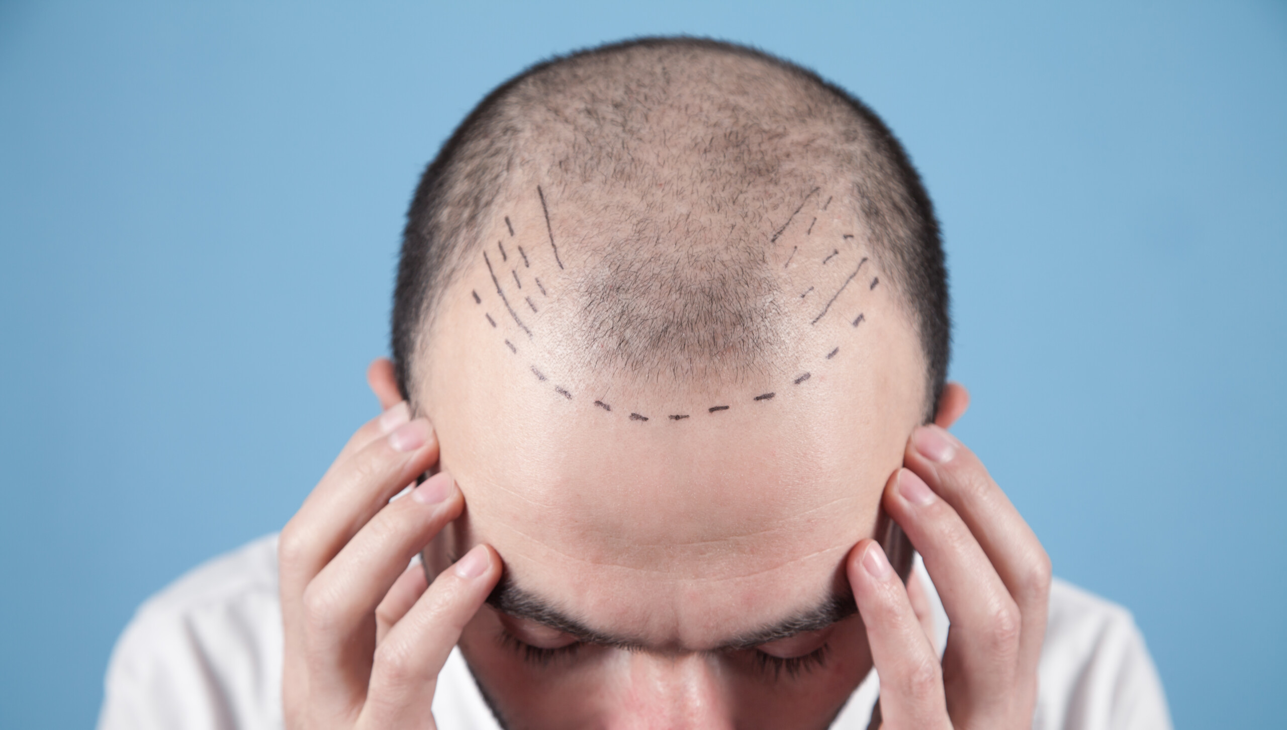Examining the Success Rate of Hair Transplants
